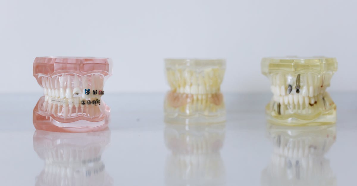 Challenges and Limitations of Endosteal Implants