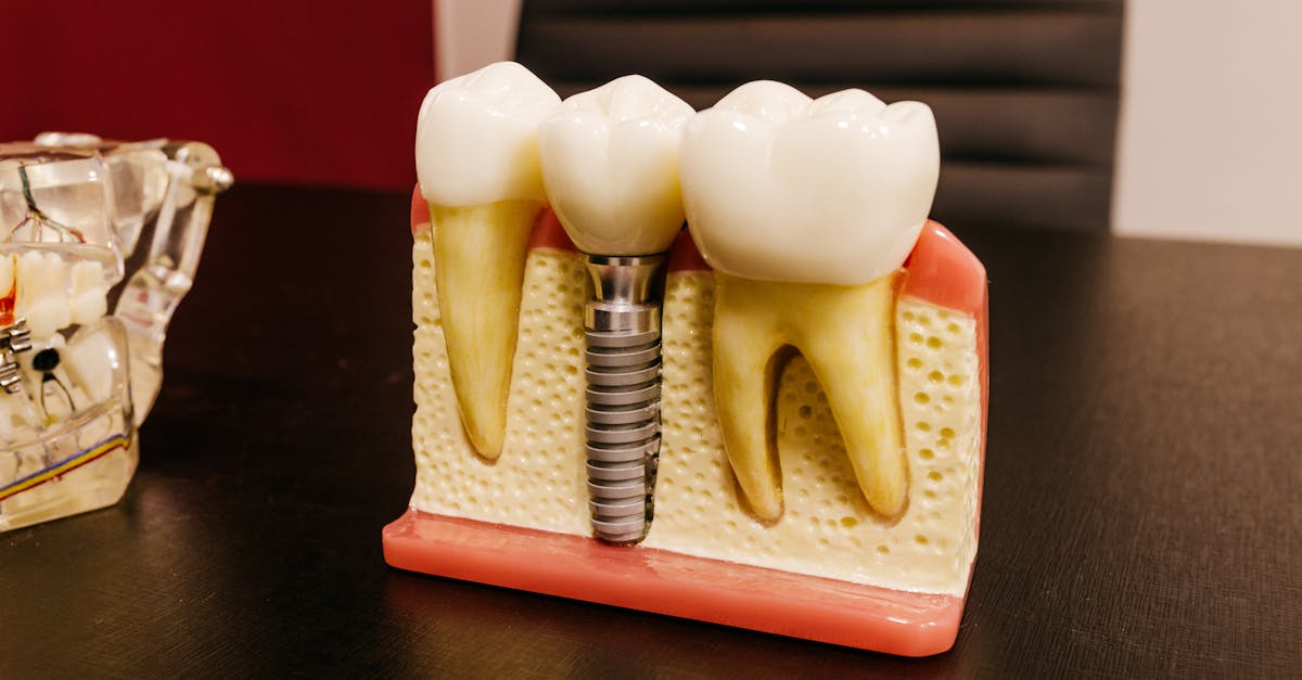 Common Mistakes in Caring for Dental Implants