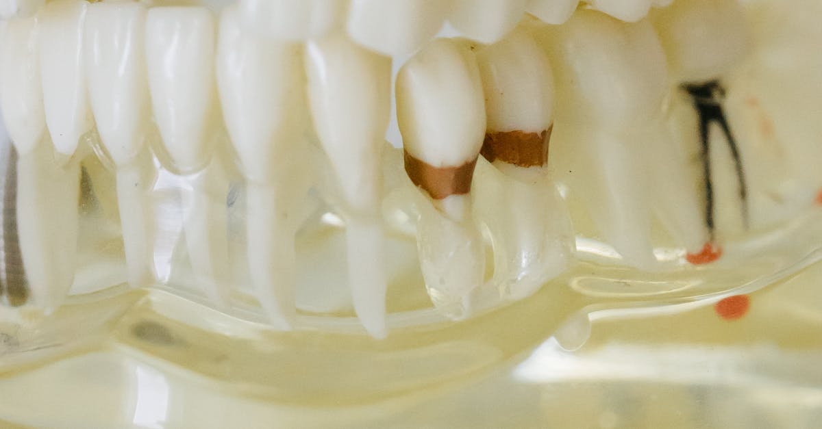 Comparing All-on-4 Implants to Traditional Dentures