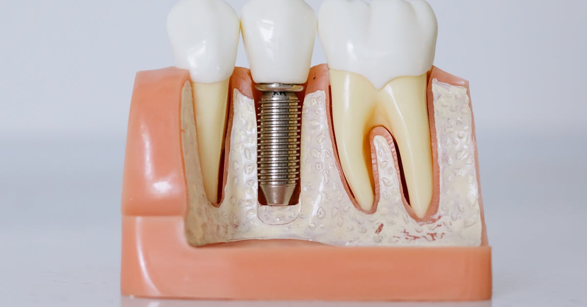 Comparing Public vs Private Insurance for Dental Implant Coverage