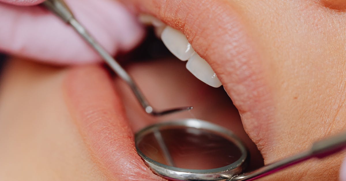 Dietary Adjustments Following All-on-4 Implant Placement