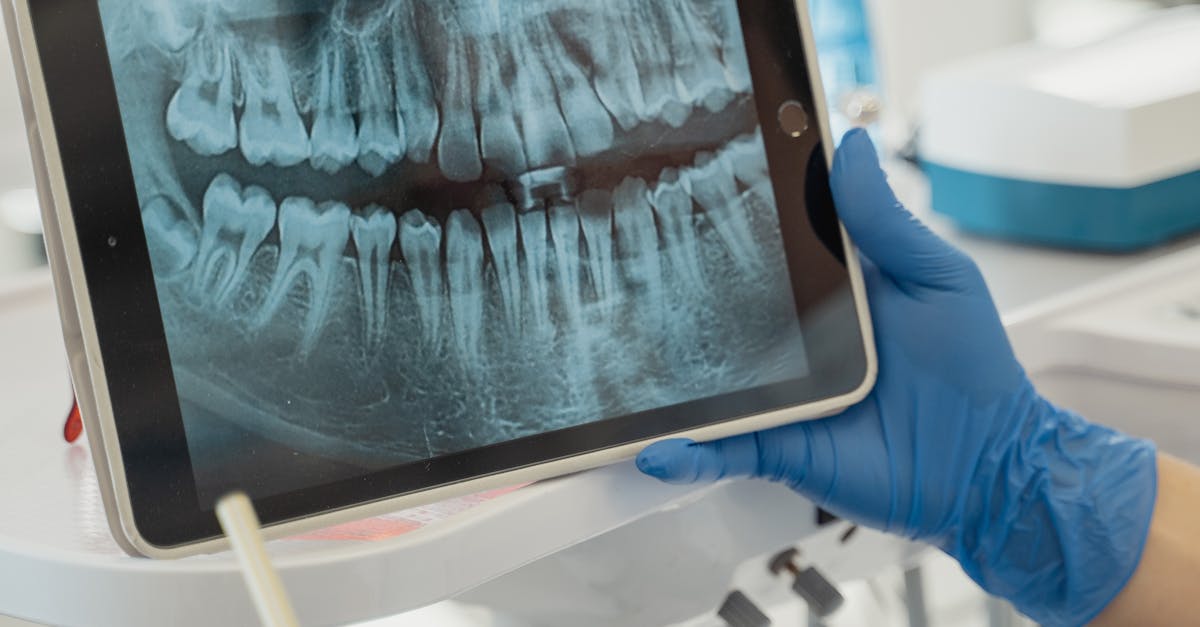 Factors Affecting the Cost of Payment Plans for Dental Implants