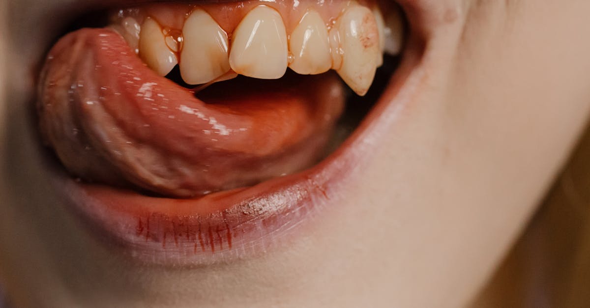 Meal Planning for Post-Dental Implant Patients