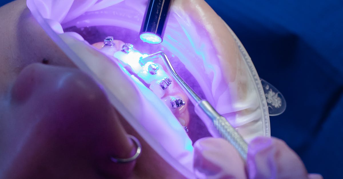 The Importance of Flossing Around Implants