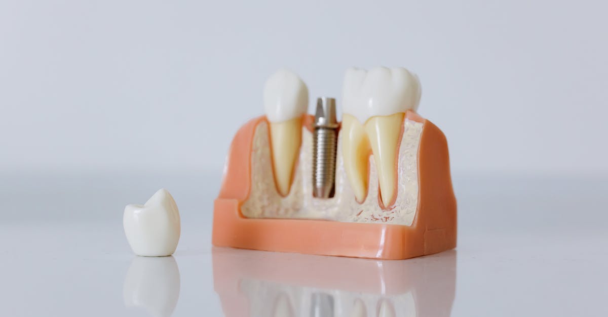 Understanding the Benefits of Zygomatic Implants for Dental Restoration